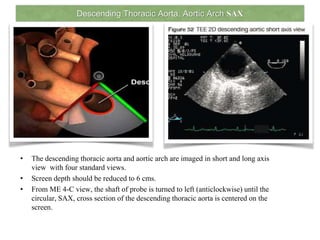 Descending Thoracic Aorta, Aortic Arch SAX
• The descending thoracic aorta and aortic arch are imaged in short and long axis
view with four standard views.
• Screen depth should be reduced to 6 cms.
• From ME 4-C view, the shaft of probe is turned to left (anticlockwise) until the
circular, SAX, cross section of the descending thoracic aorta is centered on the
screen.
 