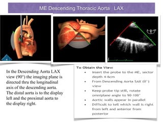 ME Descending Thoracic Aorta LAX
In the Descending Aorta LAX
view (90°) the imaging plane is
directed thru the longitudinal
axis of the descending aorta.
The distal aorta is to the display
left and the proximal aorta to
the display right.
 