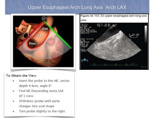 Upper Esophageal Arch Long Axis Arch LAX
 