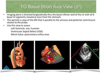 TG Basal Short Axis View (00)
• Imaging plane is directed longitudinally thru the basal inferior wall of the LV with all 6
basal LV segments viewed at once from the stomach.
• This permits a view of the MV that is parallel to the annulus and posterior commissure
closest to the probe.
• Use this view to assess
Left Ventricle: size, function
Ventricular Septal Defect (VSD)
Mitral Valve: planimetery orifice area
 