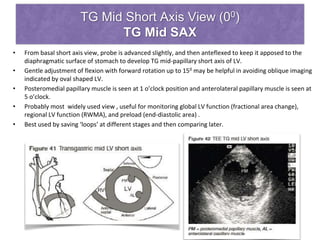 TG Mid Short Axis View (00)
TG Mid SAX
• From basal short axis view, probe is advanced slightly, and then anteflexed to keep it apposed to the
diaphragmatic surface of stomach to develop TG mid-papillary short axis of LV.
• Gentle adjustment of flexion with forward rotation up to 150 may be helpful in avoiding oblique imaging
indicated by oval shaped LV.
• Posteromedial papillary muscle is seen at 1 o’clock position and anterolateral papillary muscle is seen at
5 o’clock.
• Probably most widely used view , useful for monitoring global LV function (fractional area change),
regional LV function (RWMA), and preload (end-diastolic area) .
• Best used by saving ‘loops’ at different stages and then comparing later.
 
