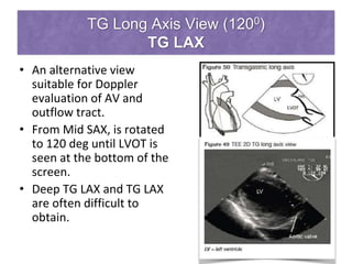 TG Long Axis View (1200)
TG LAX
• An alternative view
suitable for Doppler
evaluation of AV and
outflow tract.
• From Mid SAX, is rotated
to 120 deg until LVOT is
seen at the bottom of the
screen.
• Deep TG LAX and TG LAX
are often difficult to
obtain.
 