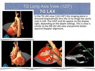 TG Long Axis View (1200)
TG LAX
In the TG LAX view (110-120°) the imaging plane is
directed longitudinally thru the LV to image the aortic
root in LAX. The LVOT and AV appear on the display
right, depending on the depth settings. This is view is
similar to the ME AV LAX view and permits better
spectral Doppler alignment.
 
