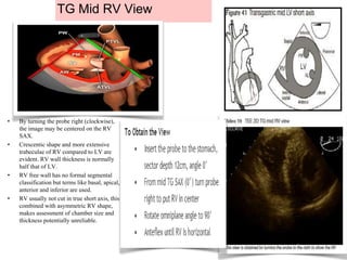 TG Mid RV View
• By turning the probe right (clockwise),
the image may be centered on the RV
SAX.
• Crescentic shape and more extensive
trabeculae of RV compared to LV are
evident. RV wall thickness is normally
half that of LV.
• RV free wall has no formal segmental
classification but terms like basal, apical,
anterior and inferior are used.
• RV usually not cut in true short axis, this
combined with asymmetric RV shape,
makes assessment of chamber size and
thickness potentially unreliable.
 