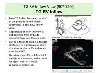 TG RV Inflow View (900-1200)
TG RV Inflow
• From TG 2-chamber view, the shaft
of the probe is turned to right
(clockwise) to obtain RV inflow
view.
• Appearance of RV in this view is
distinguished from LV by its
diamond shape and thinner walls.
• Can be difficult to obtain, alternate
strategy is to start from mid short
axis view, center on RV and rotate
transducer 900.
• This view shows RV on left and RA
on right of the screen, and is useful
for assessment of tricuspid
subvalvular apparatus.
 