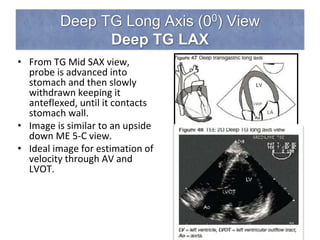 Deep TG Long Axis (00) View
Deep TG LAX
• From TG Mid SAX view,
probe is advanced into
stomach and then slowly
withdrawn keeping it
anteflexed, until it contacts
stomach wall.
• Image is similar to an upside
down ME 5-C view.
• Ideal image for estimation of
velocity through AV and
LVOT.
 