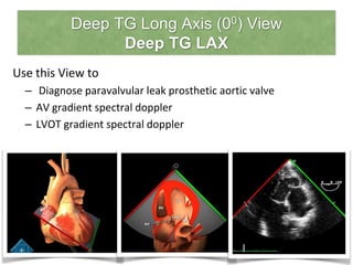 Deep TG Long Axis (00) View
Deep TG LAX
Use this View to
– Diagnose paravalvular leak prosthetic aortic valve
– AV gradient spectral doppler
– LVOT gradient spectral doppler
 