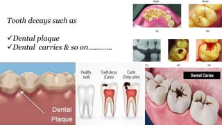 Tooth decays such as
Dental plaque
Dental carries & so on…………
 