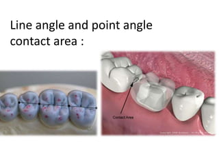 Line angle and point angle
contact area :
 
