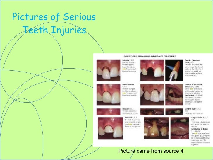 Teeth Injuries