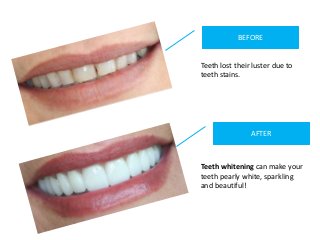 BEFORE
AFTER
Teeth lost their luster due to
teeth stains.
Teeth whitening can make your
teeth pearly white, sparkling
and ...