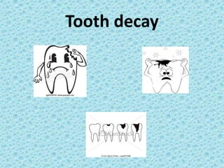 Tooth decay
 
