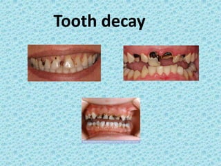 Tooth decay
 