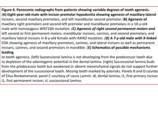 Figure 4. Panoramic radiographs from patients showing variable degrees of tooth agenesis.
(A) Eight-year-old male with incisor-premolar hypodontia showing agenesis of maxillary lateral
incisors, second maxillary premolars, and left mandibular second premolar. (B) Agenesis of
maxillary right premolars and second left premolar and mandibular premolars in a 10-y-old
male with homozygous WNT10A mutation. (C) Agenesis of right second permanent molars and
left second or first permanent molars; mandibular incisors, canines, and second premolars; and
maxillary lateral incisors in 8-y-old female with AXIN2 mutation. (D) A 7-y-old male with X-linked
EDA showing agenesis of maxillary premolars, canines, and lateral incisors as well as permanent
incisors, canines, and second premolars in mandible. (E) Schematics of possible mechanisms
leading
to tooth agenesis. (left) Successional lamina is not developing from the predecessor tooth due
to depletion of the odontogenic potential in the dental lamina. (right) Successional lamina buds
from the predecessor tooth but weakened or absent mesenchymal signals do not support further
development of the successional tooth. Missing teeth marked by asterisks. Panels B and D courtes
of Elisa Ronkainenand; panel C courtesy of Laura Lammi. dl, dental lamina; i1, first primary incisor;
I1, first permanent incisor; sl, successional lamina.
 
