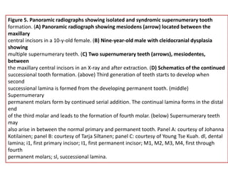Figure 5. Panoramic radiographs showing isolated and syndromic supernumerary tooth
formation. (A) Panoramic radiograph showing mesiodens (arrow) located between the
maxillary
central incisors in a 10-y-old female. (B) Nine-year-old male with cleidocranial dysplasia
showing
multiple supernumerary teeth. (C) Two supernumerary teeth (arrows), mesiodentes,
between
the maxillary central incisors in an X-ray and after extraction. (D) Schematics of the continued
successional tooth formation. (above) Third generation of teeth starts to develop when
second
successional lamina is formed from the developing permanent tooth. (middle)
Supernumerary
permanent molars form by continued serial addition. The continual lamina forms in the distal
end
of the third molar and leads to the formation of fourth molar. (below) Supernumerary teeth
may
also arise in between the normal primary and permanent tooth. Panel A: courtesy of Johanna
Kotilainen; panel B: courtesy of Tarja Siltanen; panel C: courtesy of Young Tse Kuah. dl, dental
lamina; i1, first primary incisor; I1, first permanent incisor; M1, M2, M3, M4, first through
fourth
permanent molars; sl, successional lamina.
 