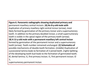 Figure 6. Panoramic radiographs showing duplicated primary and
permanent maxillary central incisors. (A) An 8-y-old male with
duplication of primary maxillary right central incisor (arrow), most
likely formed by gemination of the primary incisor and a supernumerary
tooth. In addition to the primary doubled incisor, a small supernumerary
tooth is visible in the apical region of the primary tooth (arrow).
(B) A 11-y-old male with a permanent maxillary left central incisor
formed by gemination of the permanent incisor and a supernumerary
tooth (arrow). Tooth number remained unchanged. (C) Schematics of
possible mechanisms of double-tooth formation. (middle) Duplication of
successional lamina leads to formation of 2 joined teeth. (right) Splitting
of the developing tooth bud leads to the formation of geminated tooth.
dl, dental lamina; i1, first primary incisor; I1, first permanent incisor; I2
1,
supernumerary permanent incisor.
 