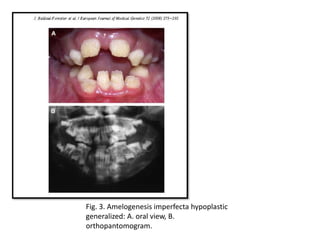 Fig. 3. Amelogenesis imperfecta hypoplastic
generalized: A. oral view, B.
orthopantomogram.
 