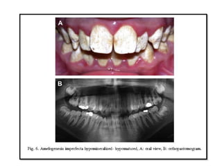 dental abnormalities on genetic background (new vision).pptx