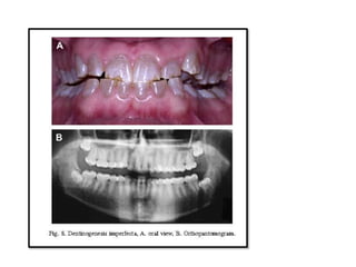 dental abnormalities on genetic background (new vision).pptx