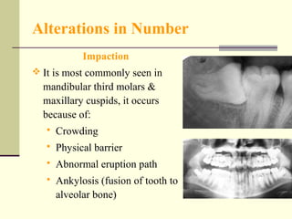 Teeth abnormalities ii | PPT