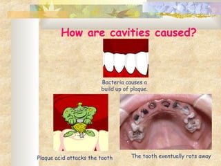 How are cavities caused?
Bacteria causes a
build up of plaque.
Plaque acid attacks the tooth The tooth eventually rots away
 