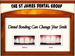 Dental Bonding Can Change Your Smile
Before After
 