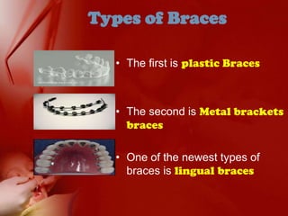 Types of BracesThe first is plastic BracesThe second is Metal brackets bracesOne of the newest types of braces is lingual braces