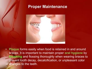 Proper MaintenancePlaqueforms easily when food is retained in and around braces. It is important to maintain proper oral hygiene by brushing and flossing thoroughly when wearing braces to prevent tooth decay, decalcification, or unpleasant color changes to the teeth.