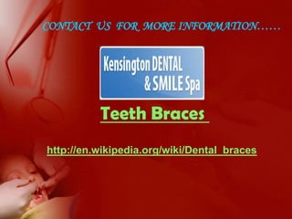 Contact Us for more Information……Teeth Braces http://en.wikipedia.org/wiki/Dental_braces