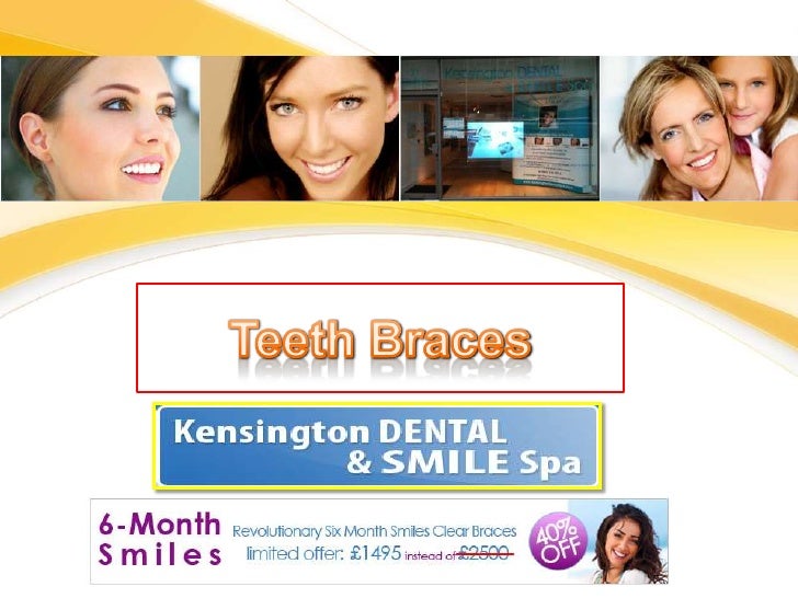 Teeth braces london kensington