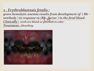 
2 . Erythroblastosis fetalis :
grave hemolytic anemia results from development of ( Rh –
antibody ) in response to (Rh –factor ) in the fetal blood .
Clinically : teeth are bluish or greenish in color .
Treatment : bleaching .
 