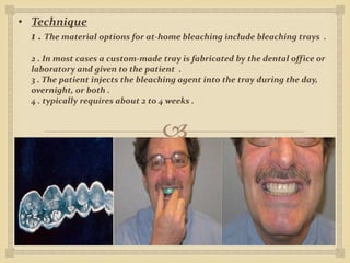 
• Technique
1 . The material options for at-home bleaching include bleaching trays .
2 . In most cases a custom-made tray is fabricated by the dental office or
laboratory and given to the patient .
3 . The patient injects the bleaching agent into the tray during the day,
overnight, or both .
4 . typically requires about 2 to 4 weeks .
 