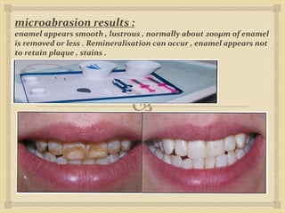 
microabrasion results :
enamel appears smooth , lustrous , normally about 200µm of enamel
is removed or less . Remineralisation can occur , enamel appears not
to retain plaque , stains .
 
