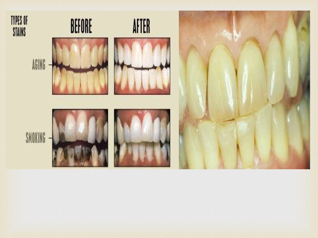Teeth discoloration