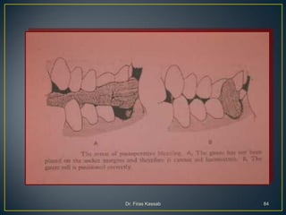 Teeth extraction(1) | PDF