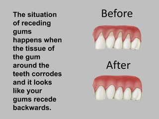 The situation
of receding
gums
happens when
the tissue of
the gum
around the
teeth corrodes
and it looks
like your
gums recede
backwards.
Before
After
 