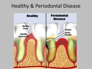 Healthy & Periodontal Disease
 
