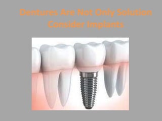 Dentures Are Not Only Solution
Consider Implants
 