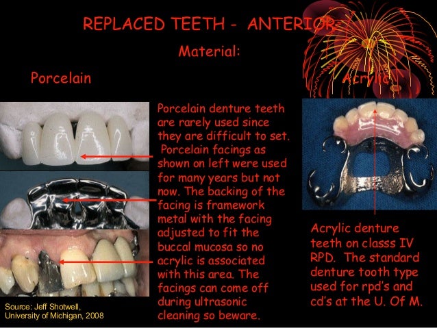 Teeth of Removable Partial Denture