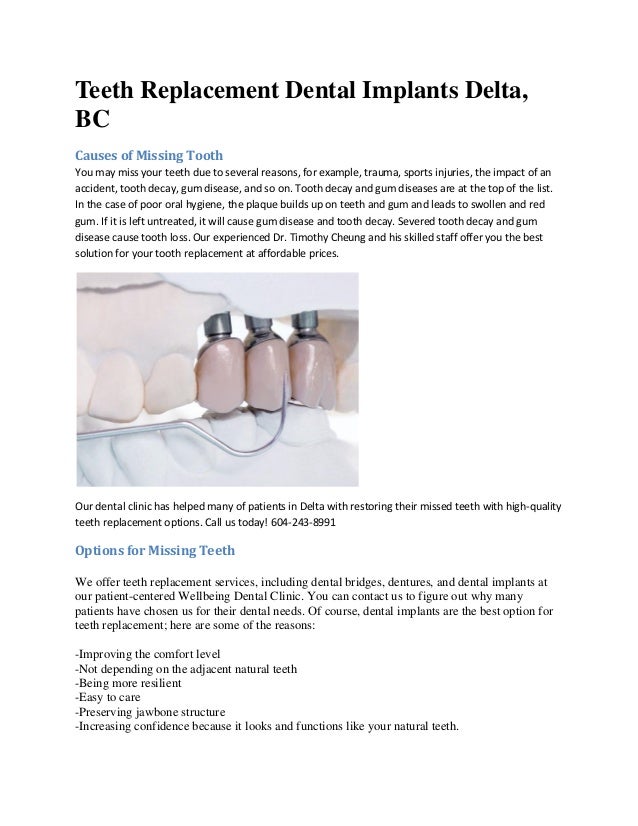 Teeth replacement dental implants delta