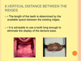 6.VERTICAL DISTANCE BETWEEN THE
RIDGES
 • The length of the teeth is determined by the
available space between the existing ridges.
 • It is advisable to use a tooth long enough to
eliminate the display of the denture base.
 