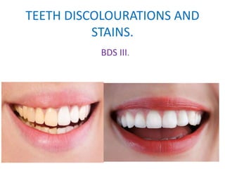 TEETH DISCOLOURATIONS AND
STAINS.
BDS III.
 