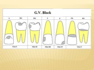 Teeth structure and cavities