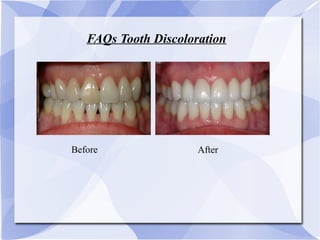 FAQs Tooth Discoloration
Before After
 