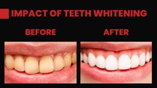 IMPACT OF TEETH WHITENING
BEFORE AFTER
 