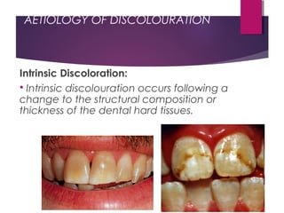 AETIOLOGY OF DISCOLOURATION
Intrinsic Discoloration:
 Intrinsic discolouration occurs following a
change to the structural composition or
thickness of the dental hard tissues.
 