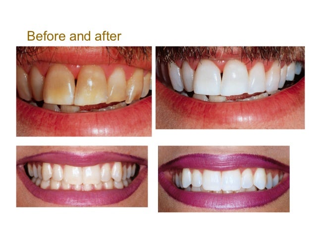 Teeth whitening lecture(1)