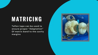 MATRICING
Teflon tape can be used to
ensure proper “Adaptation”
Of matrix band to the cavity
margins
 