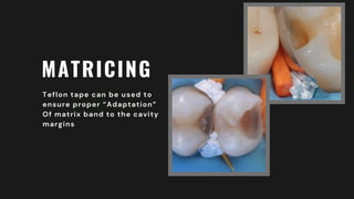 MATRICING
Teflon tape can be used to
ensure proper “Adaptation”
Of matrix band to the cavity
margins
 