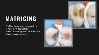 MATRICING
Teflon tape can be used to
ensure “Adaptation
&sufficient space” in Back to
Back restorations
 
